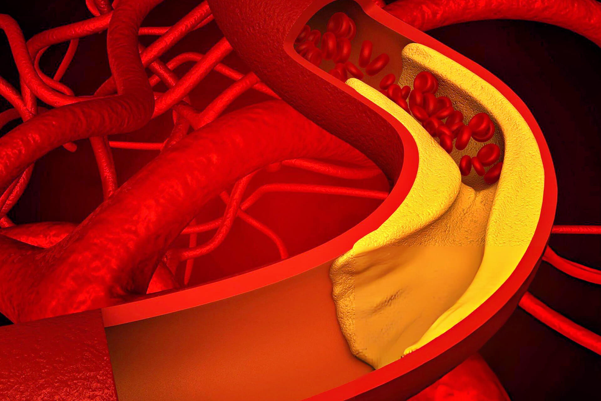 KOMPLEKS KORONER GİRİŞİMLER